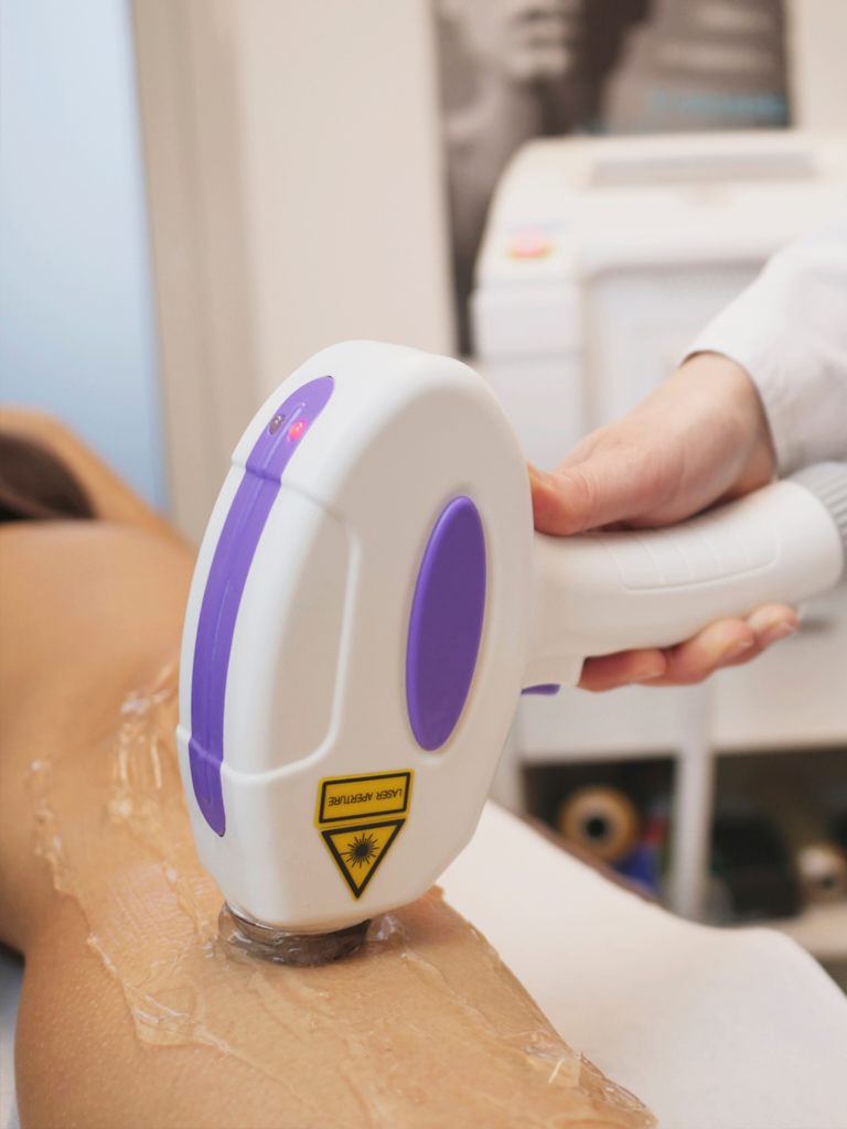 epilazione_laser