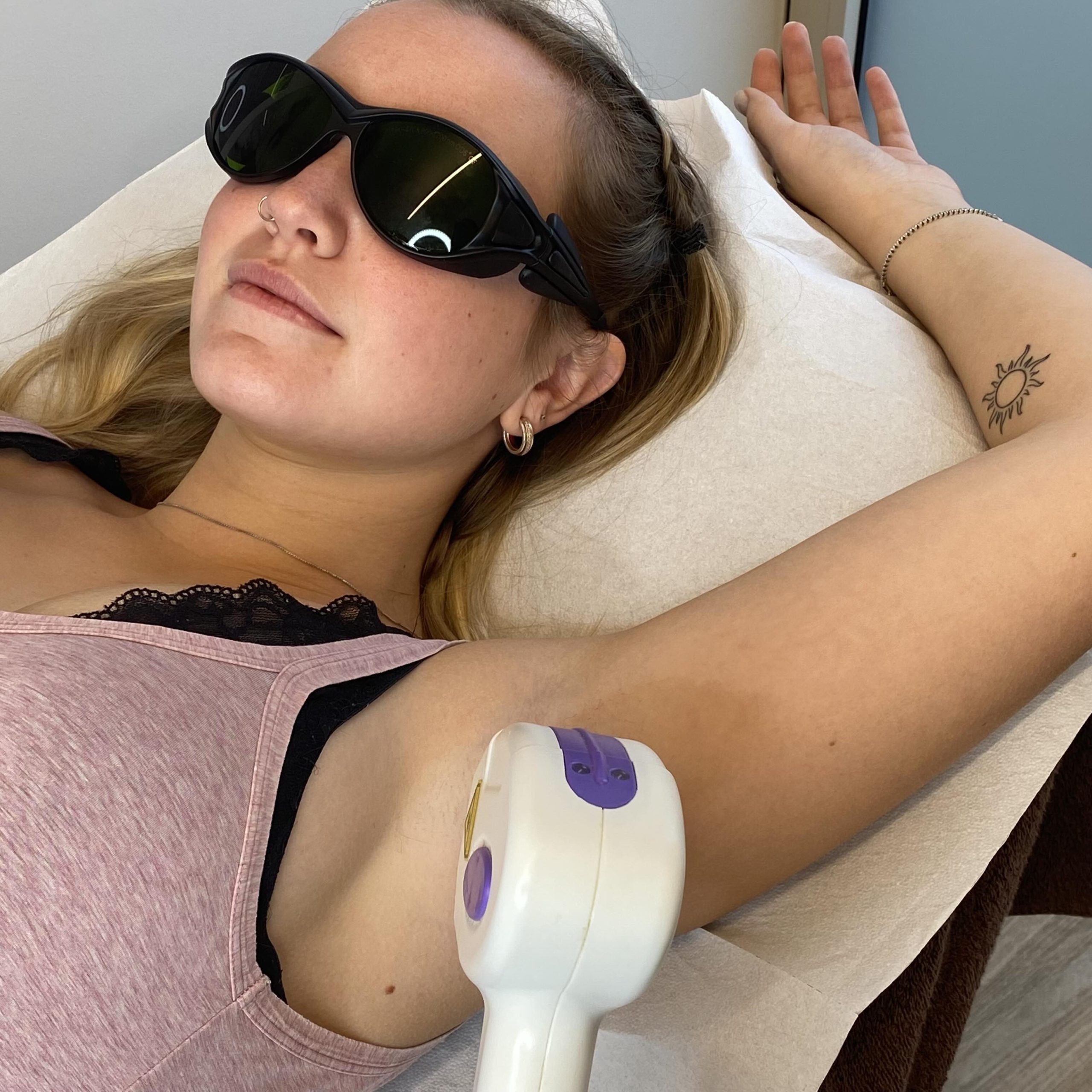 epilazione_laser